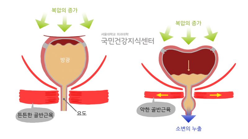 겨울-26_겨울철-악회됙-쉬운-요실금-(1)