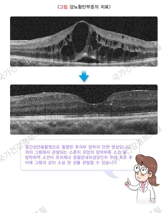 당뇨망막병증 | 국민건강지식센터